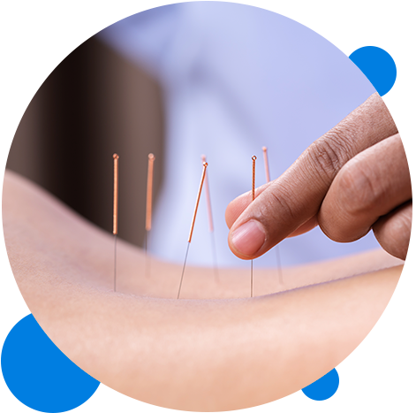 Acupuntura